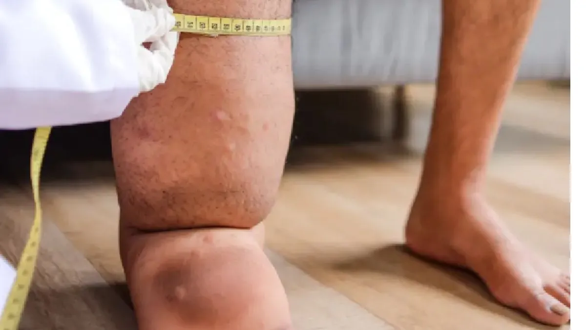 Is Your Swelling Lymphedema? How to Tell and What to Do Next