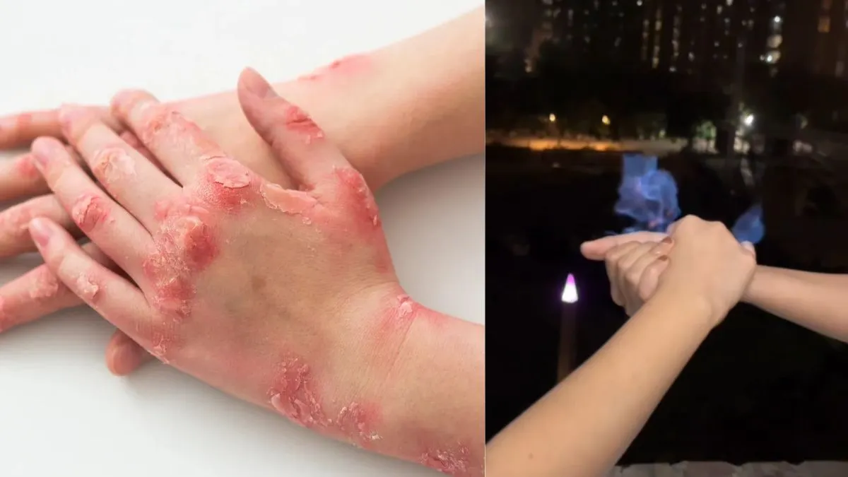 Burnt Hand After Viral Diwali Handshake? Here’s How to Heal It Fast