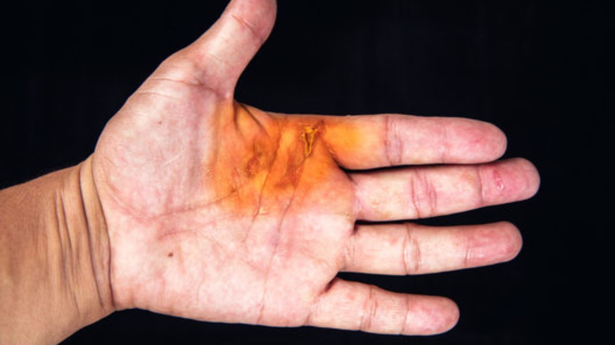 Burnt Hand Diwali Burnt Hand Diwali