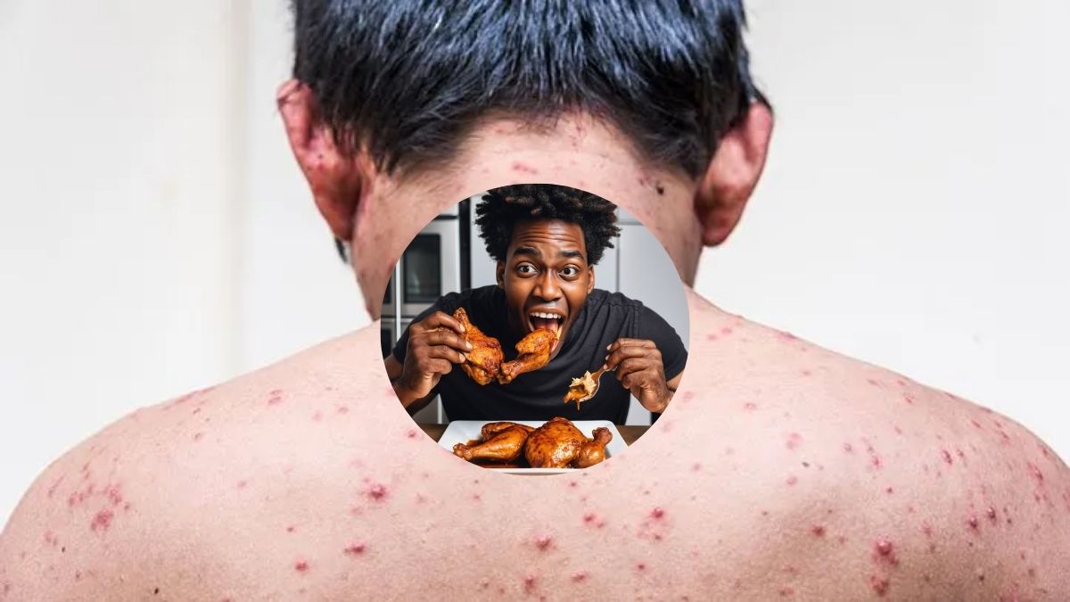 Eating Chicken During Chickenpox: Safe or Risky? Nutrition Tips for Faster Healing