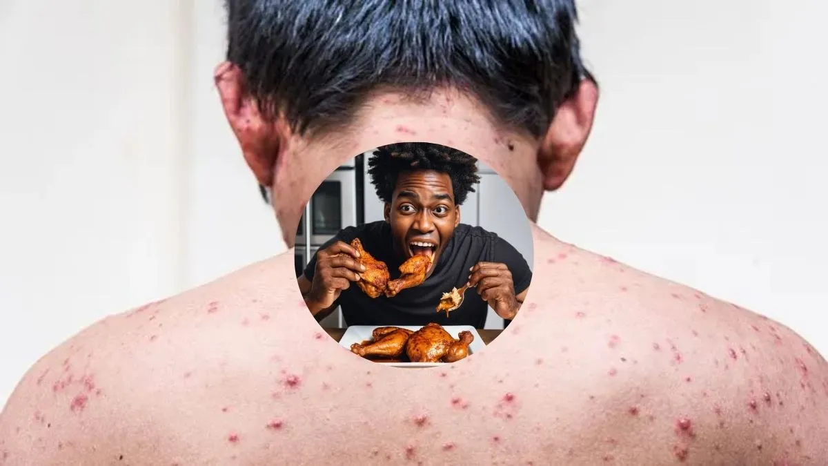 Eating Chicken During Chickenpox: Safe or Risky? Nutrition Tips for Faster Healing