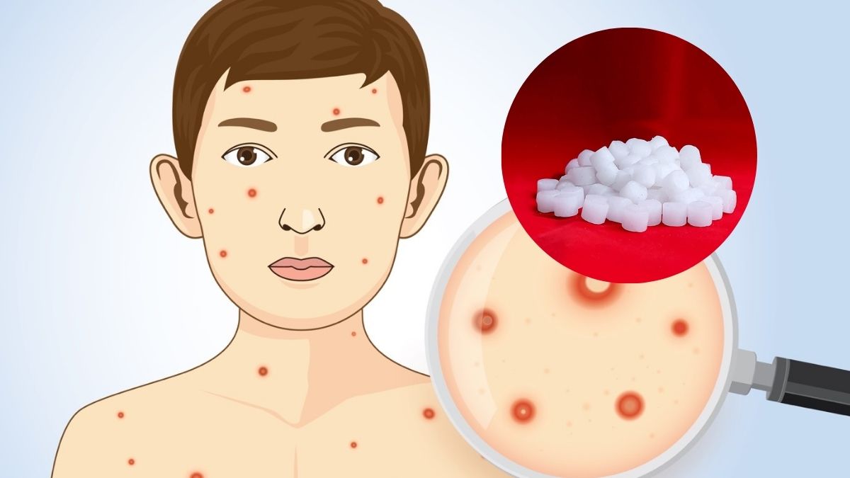 Is Camphor Safe and Effective for Chickenpox? What You Need to Know