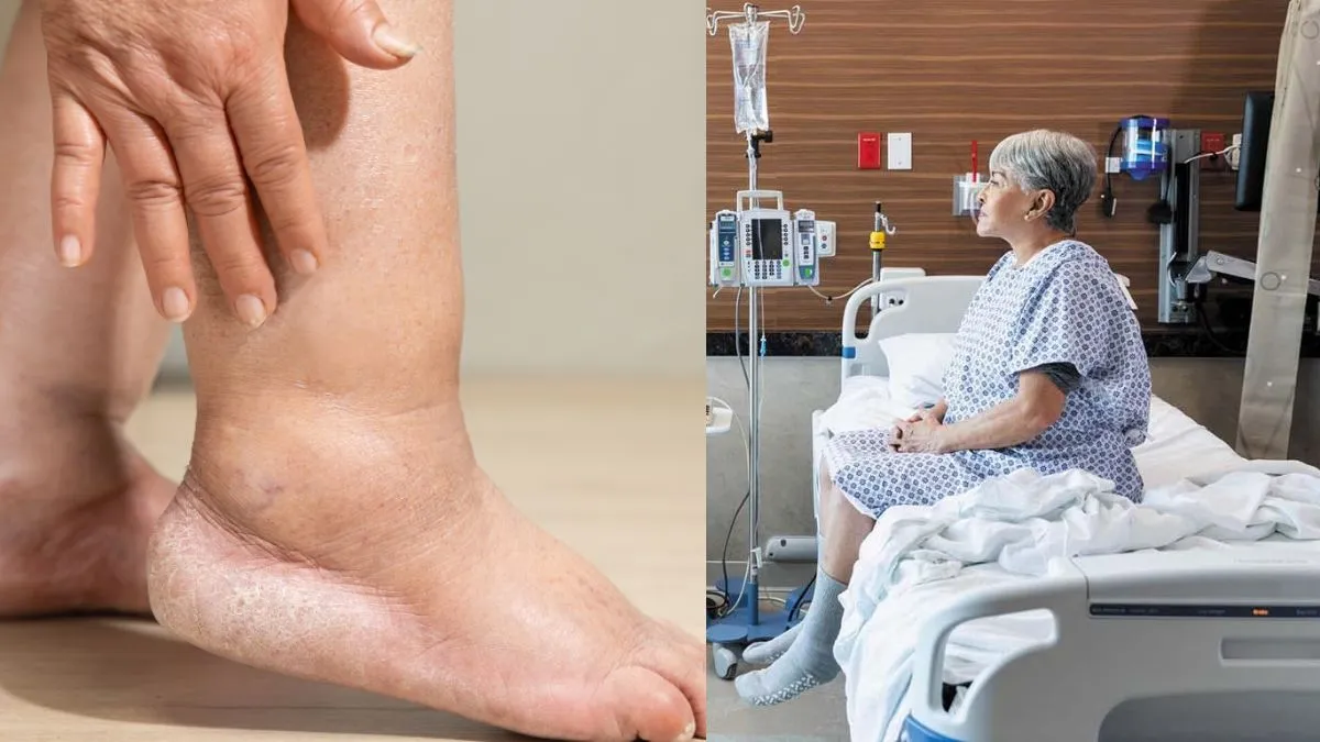 Why Do Cancer Patients Get Lymphedema? Doctor Explains the Link
