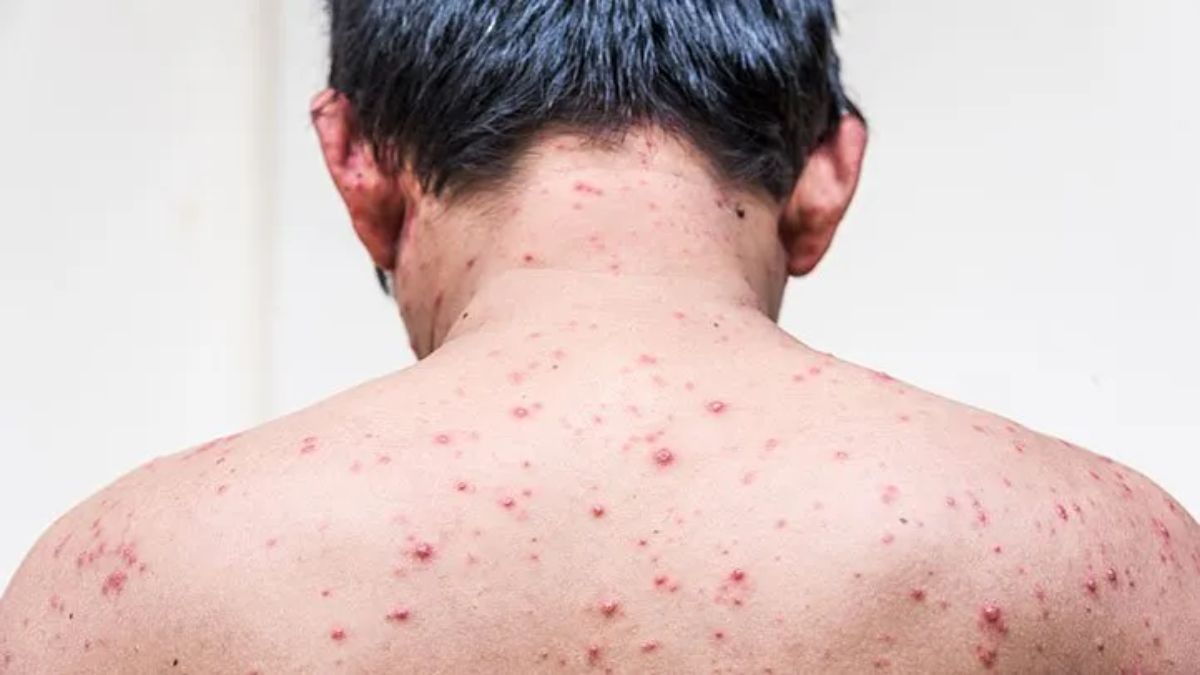 Chickenpox In Adulthood: Causes, Risks, and Late Age Limits