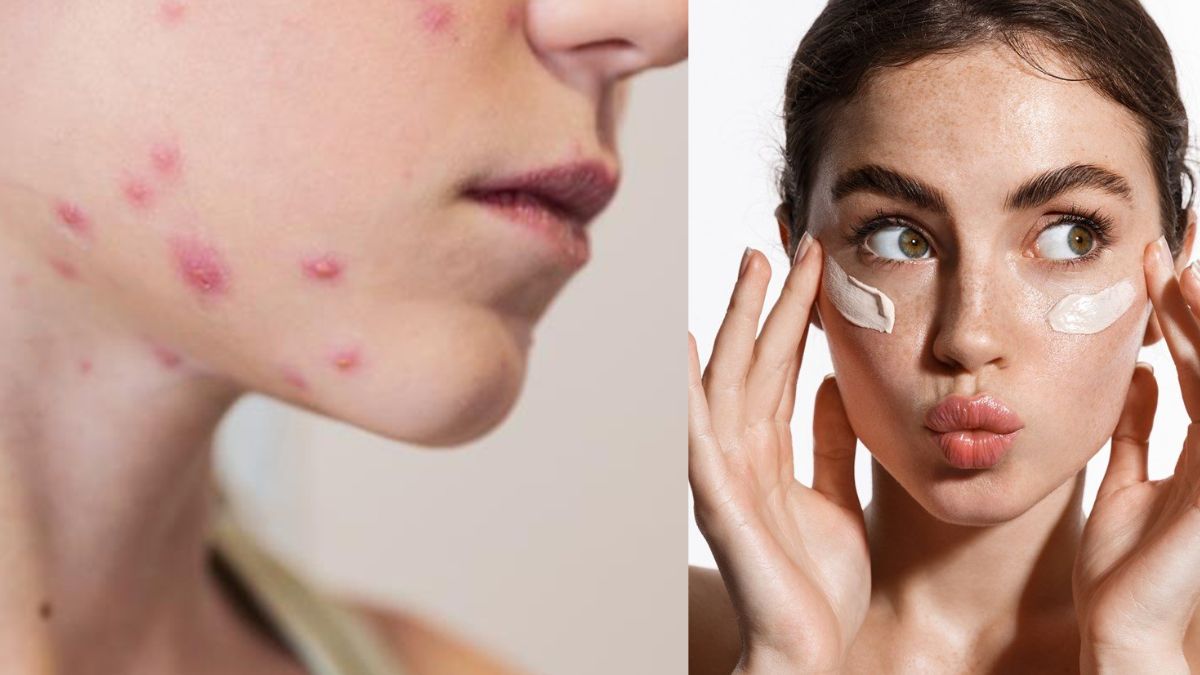 Should You Apply Sunscreen To Chickenpox Scars? We Asked An Expert