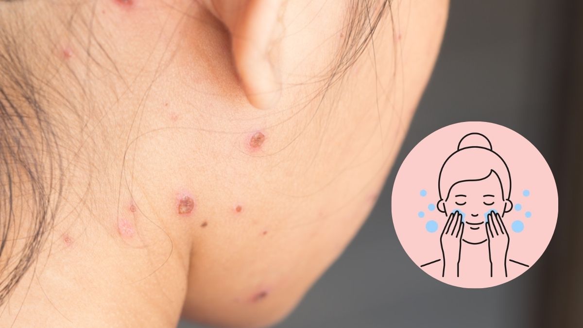 How To Clean Your Face Safely During Chickenpox? Know From An Expert