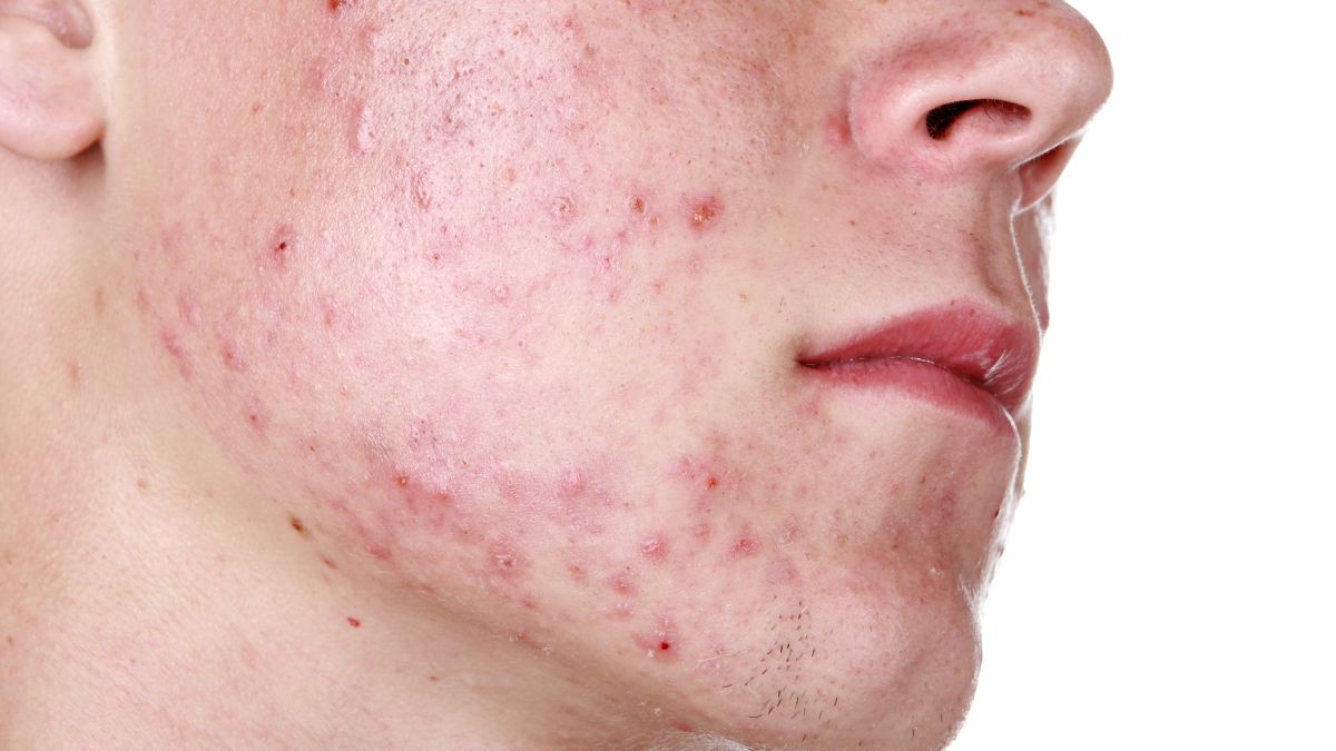 sunscreen on chickenpox scars