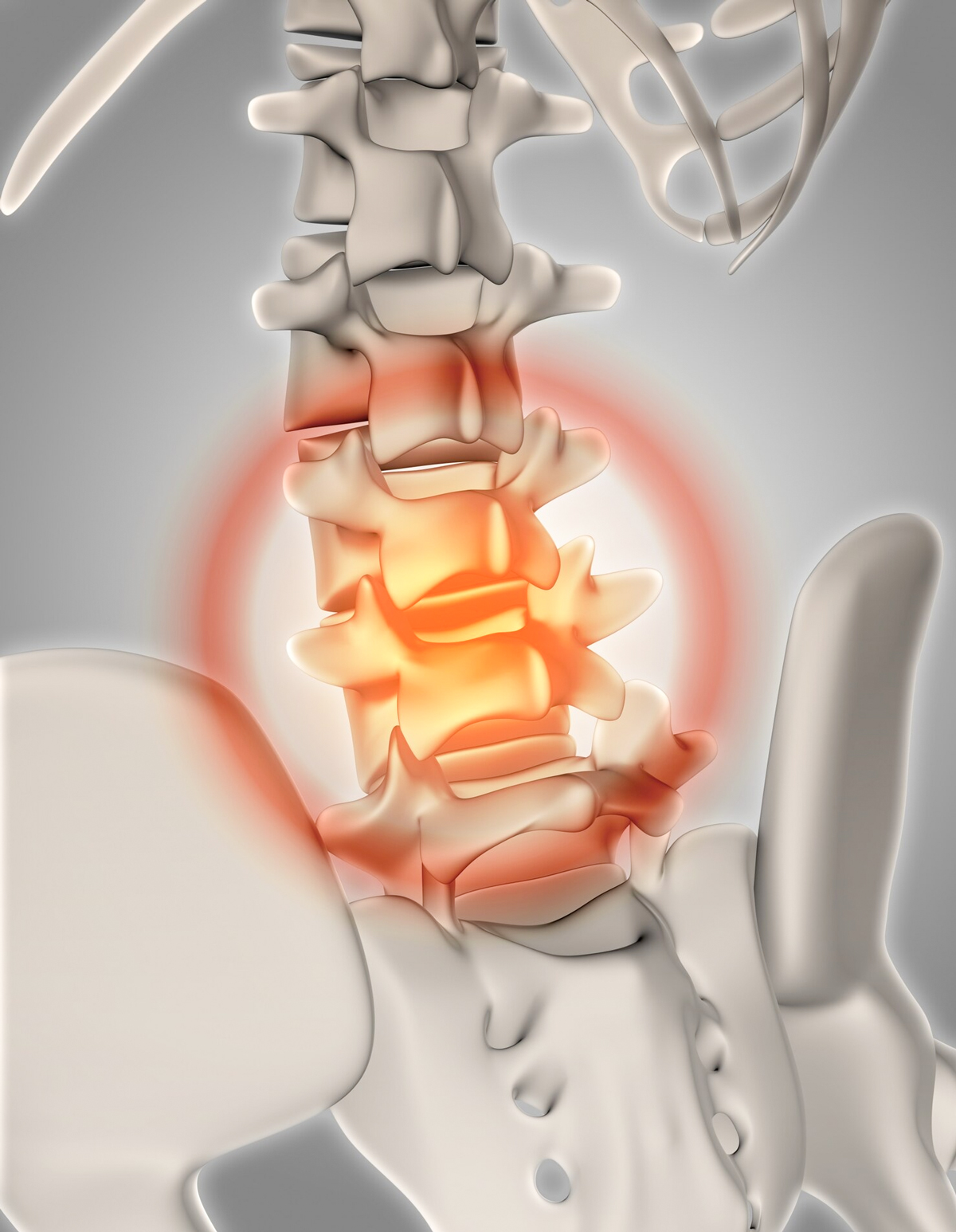 Slip Disc and Sciatica 1