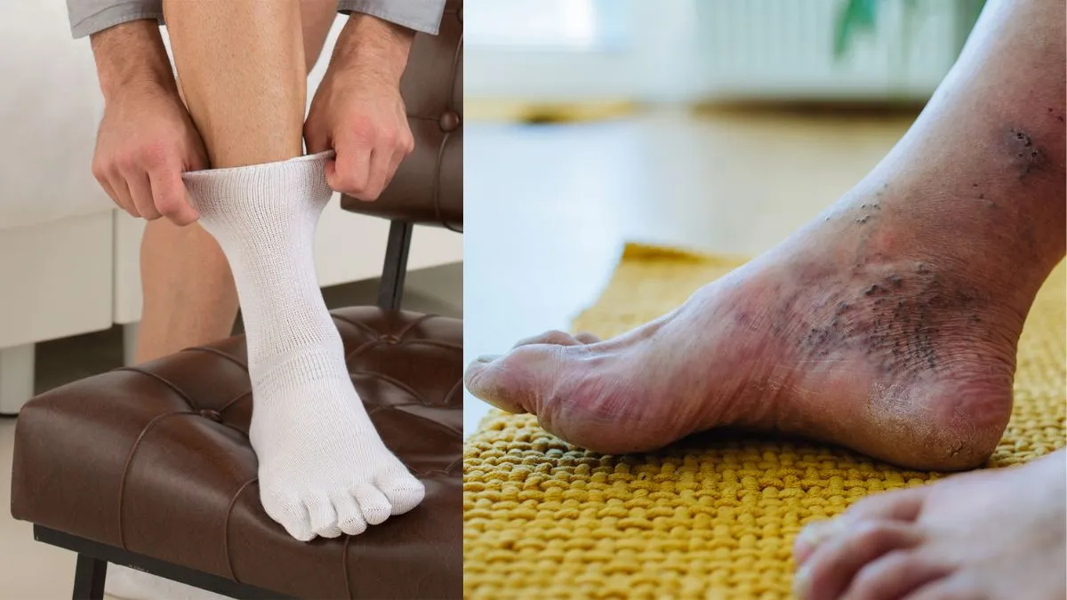 World Diabetes Day 2025: Expert Explains Diabetic Foot’s Symptoms, Early Warning Signs, Treatment, and the Role of Diabetic Socks
