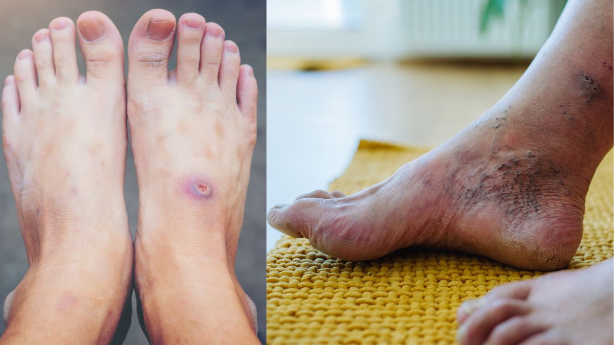 World Diabetes Day diabetic foot