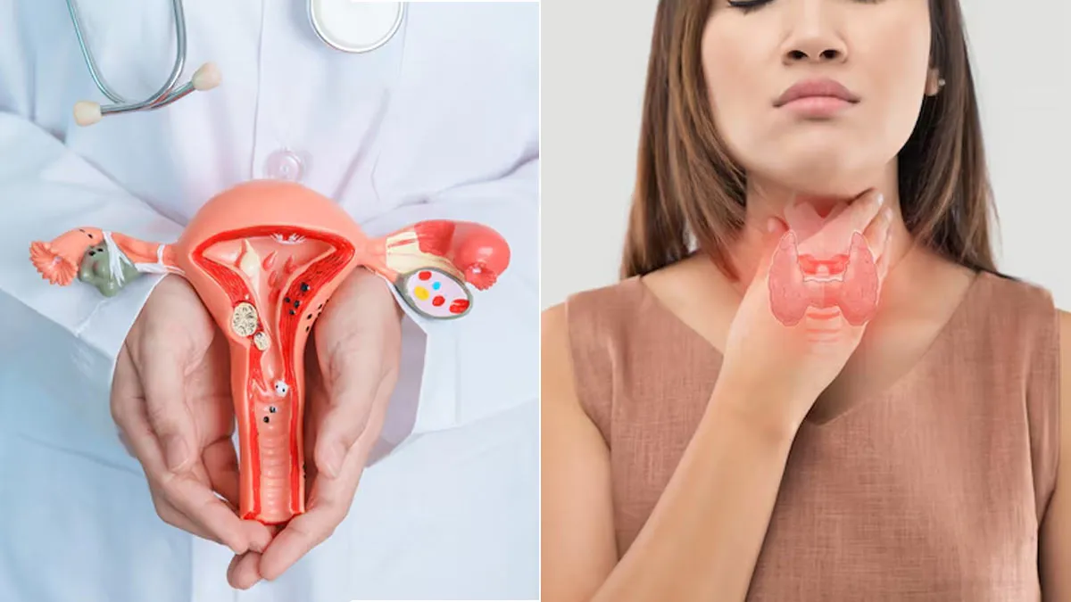 Why Are PCOS and Thyroid Issues Rising Rapidly Among Gen Z Women?