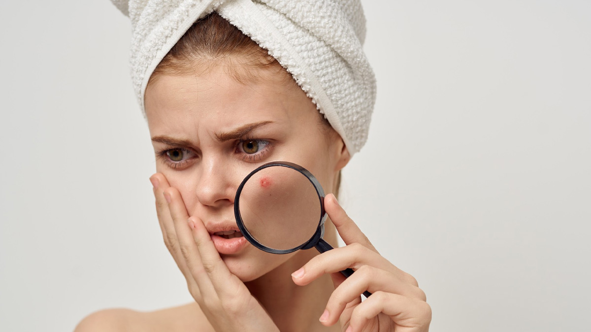 Can Cutting Out Dairy Actually Clear Up Adult Acne? Find Out Here