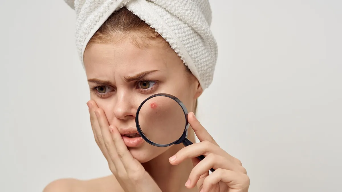 Can Cutting Out Dairy Actually Clear Up Adult Acne? Find Out Here