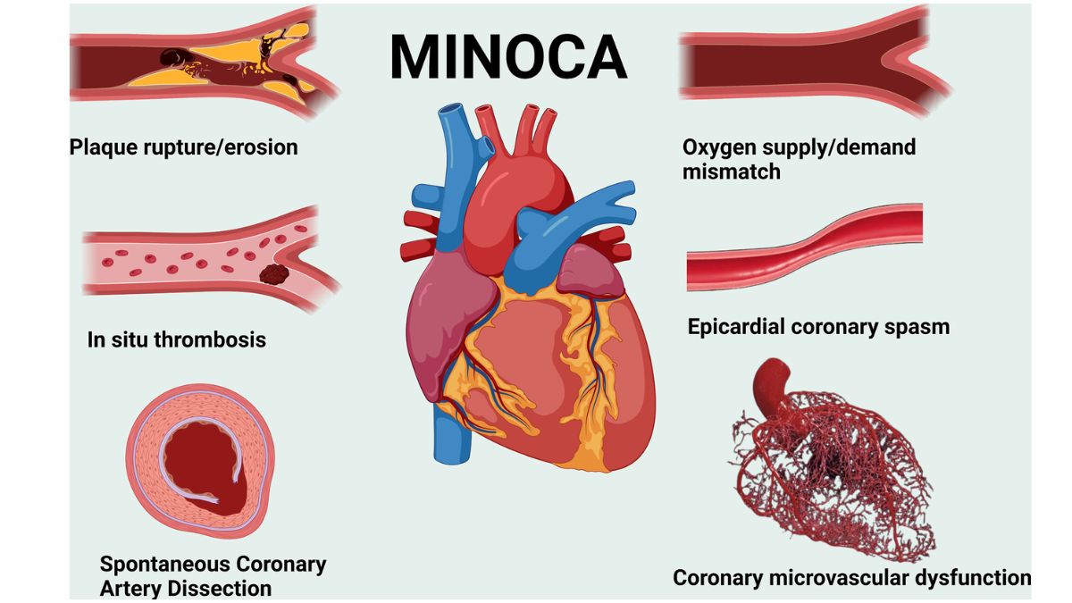 minoca heart attack minoca heart attack