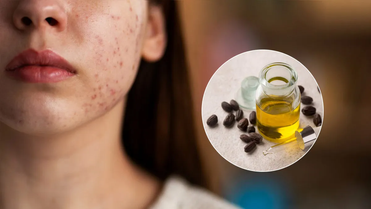 Why Jojoba Oil Is Perfect For Acne-Prone Skin