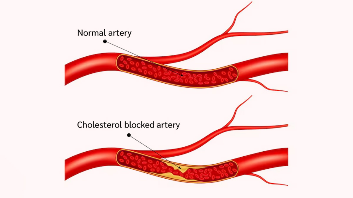 clogged arteries inside