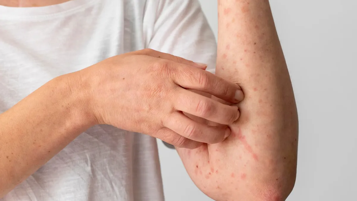 Bengaluru Doctor Explains Why Measles Outbreak In The US Is A Warning For India Too