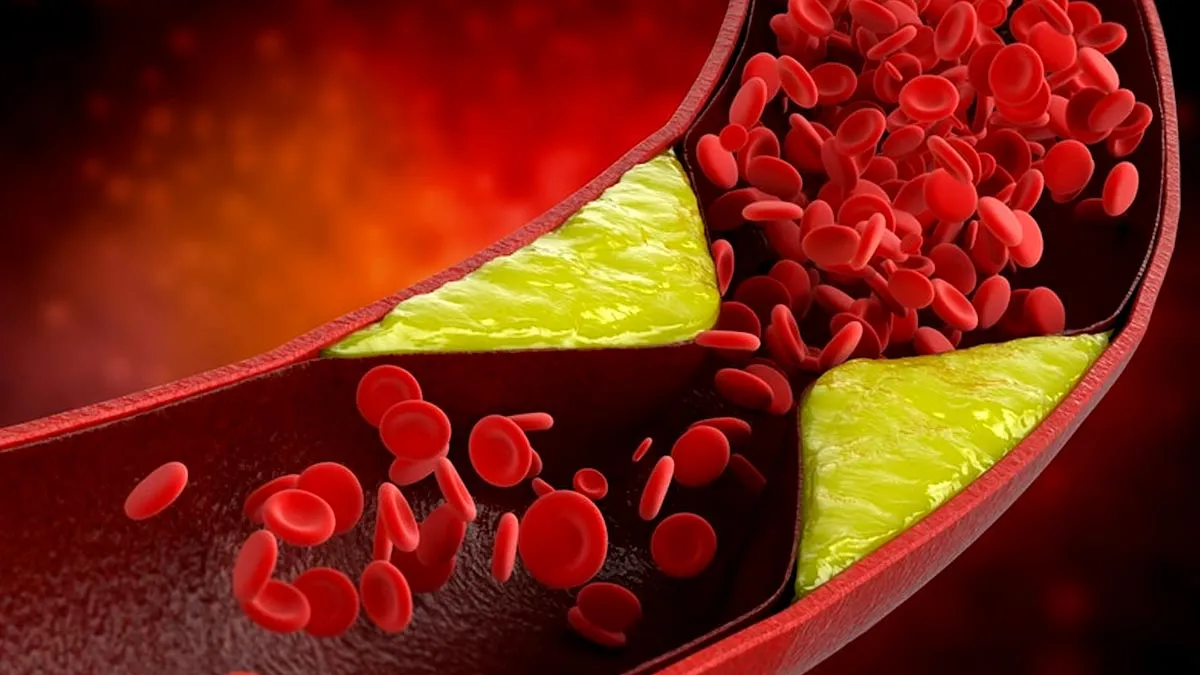 Study Reveals Why Thin People Can Have High Cholesterol, Shows How Genes Matter More Than Weight