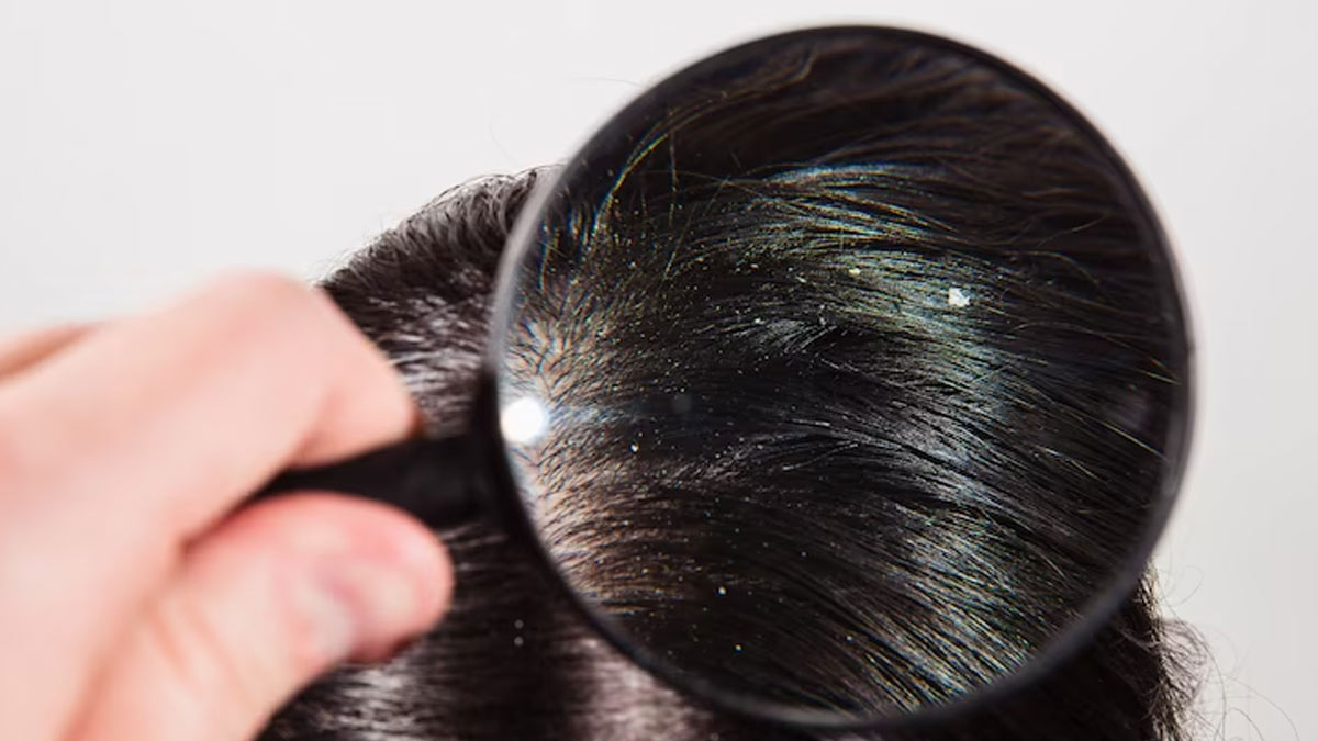 Winter Dandruff: Why the Flakes Increase and If Scalp Serums Are the Answer, Expert Shares