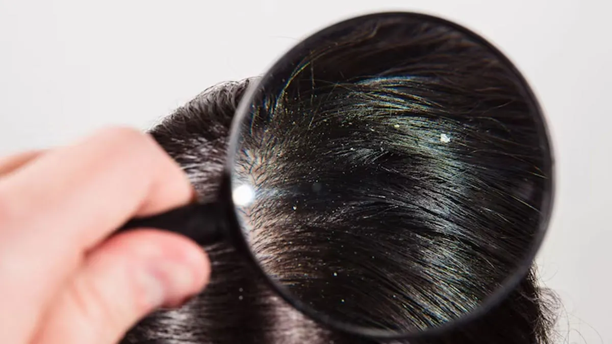 Winter Dandruff: Why the Flakes Increase and If Scalp Serums Are the Answer, Expert Shares
