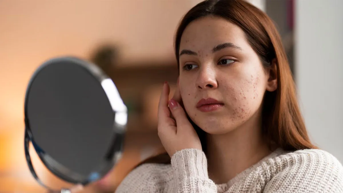 Is Chronic Stress Linked To Adult Acne?