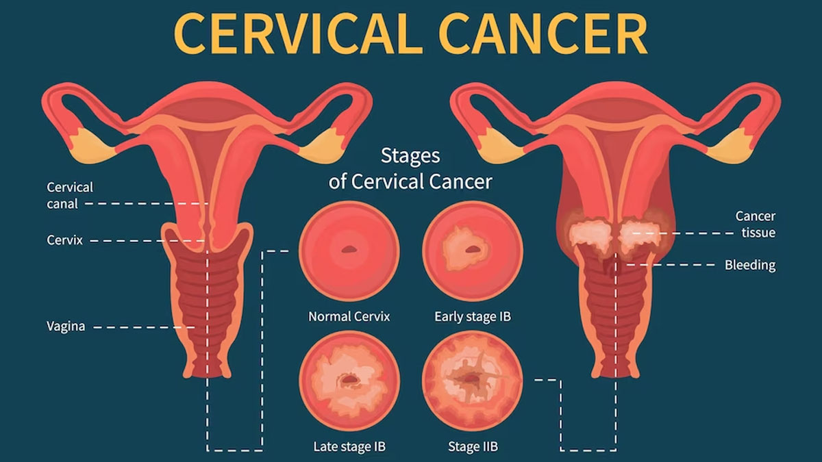 cervical-cancer