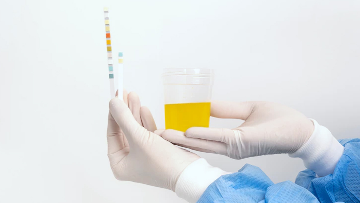 2-Kidney Stones Cause Blood in Urine