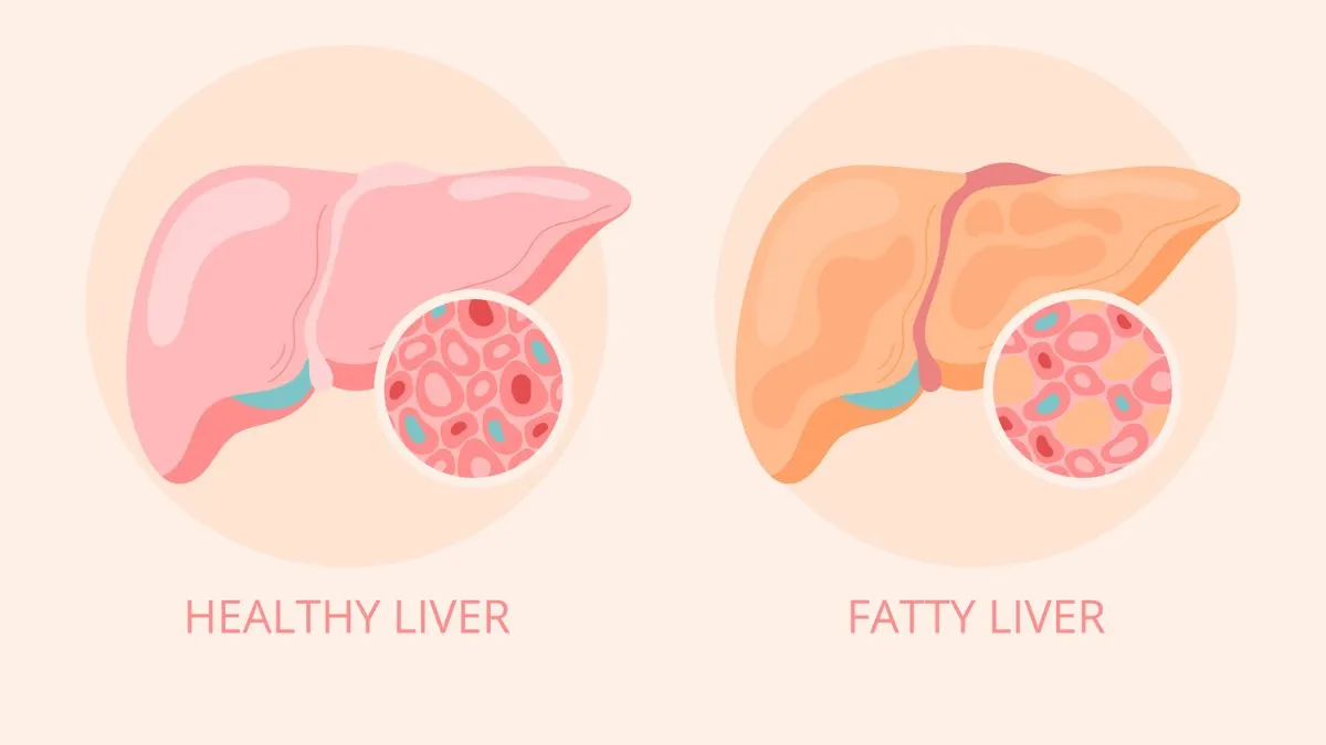 Grade 1 Fatty Liver: Causes, Symptoms, Diagnosis, and Treatment