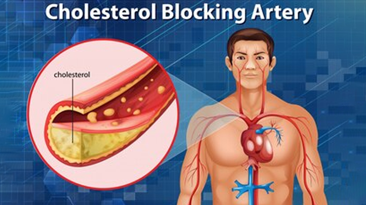 cholesterol diagram