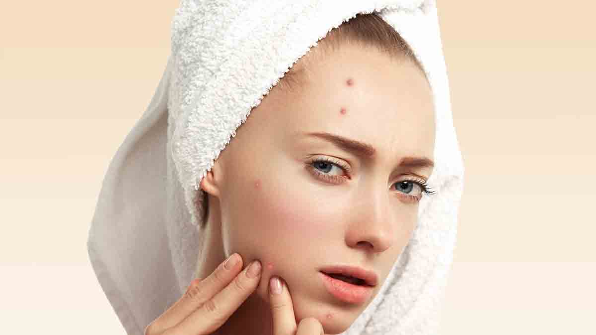 pimple patch 1