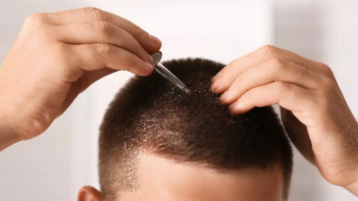 Minoxidil Side Effects: Dermatologist Explains What to Expect and When to Worry