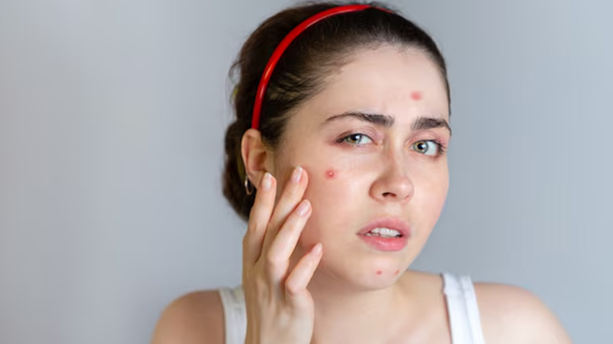 toothpaste pimples  1