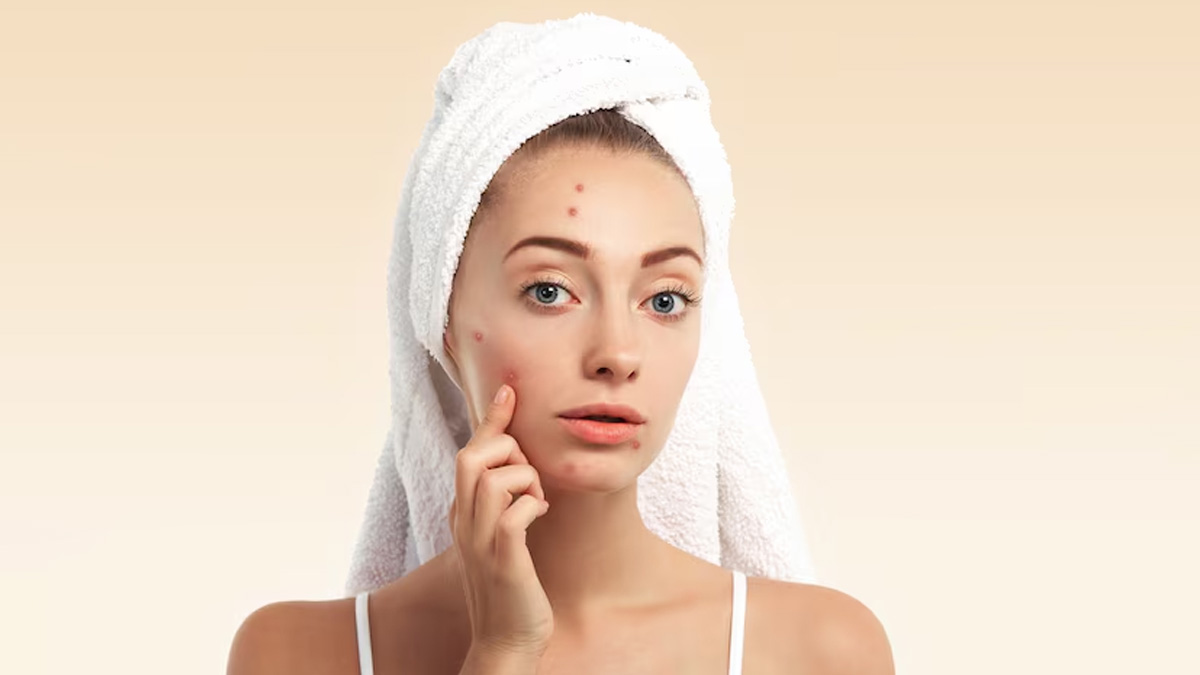 toothpaste pimples 3
