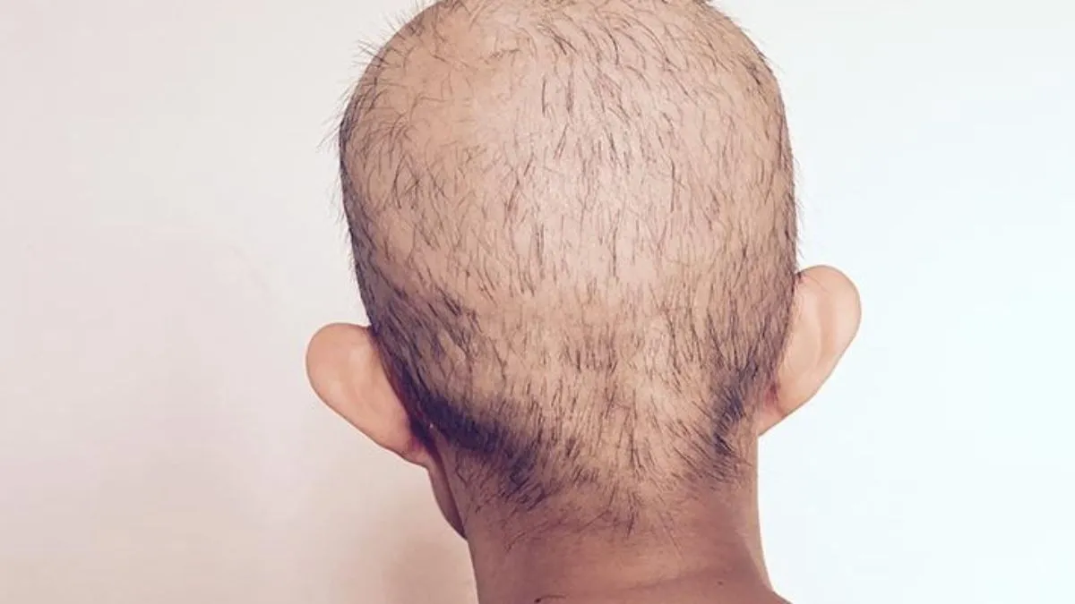 When Is It Safe to Dye Your Hair After Chemo? An Oncologist Explains