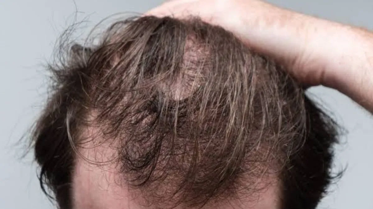 Thinking of Stopping Minoxidil? Here's What Your Hair Will Do Next