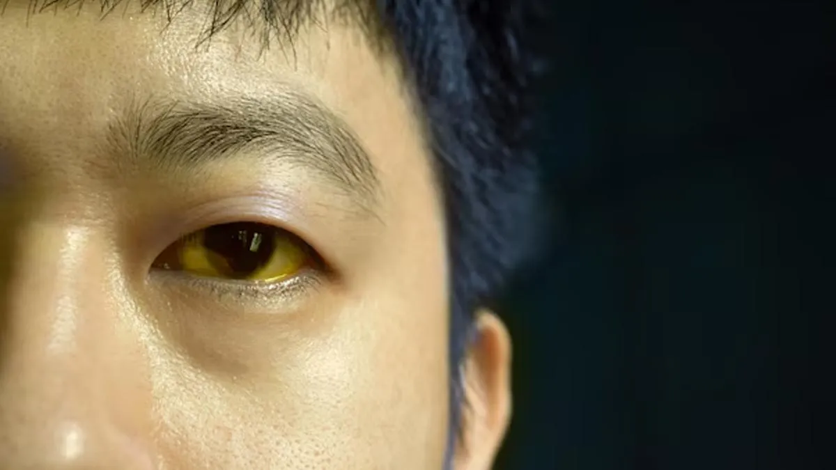 jaundice bland food 2