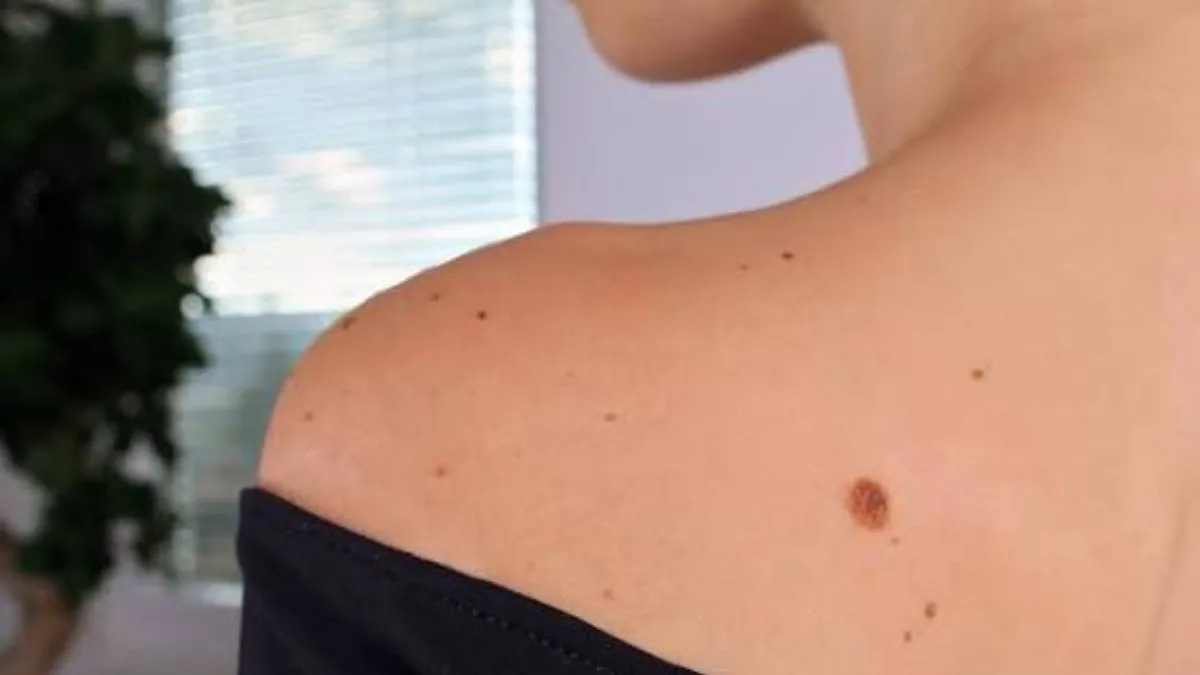 mole on body