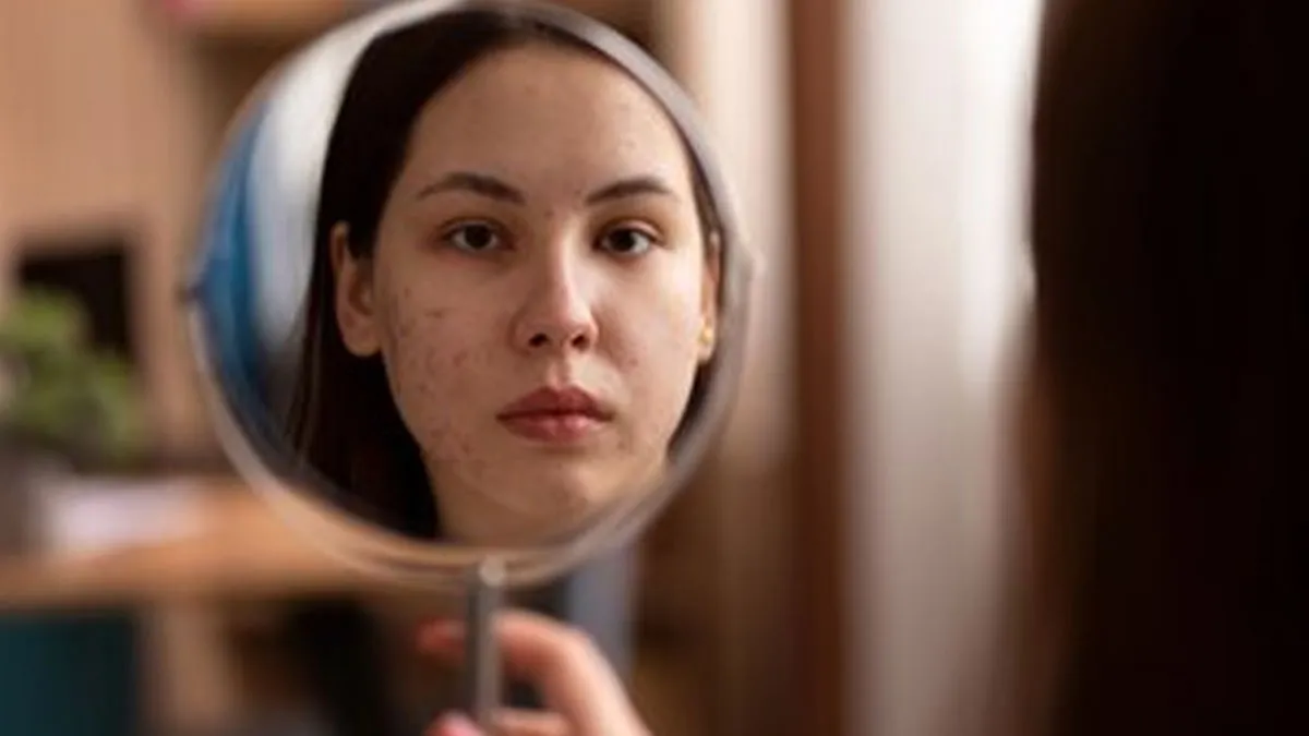 fungal vs regular acne 1