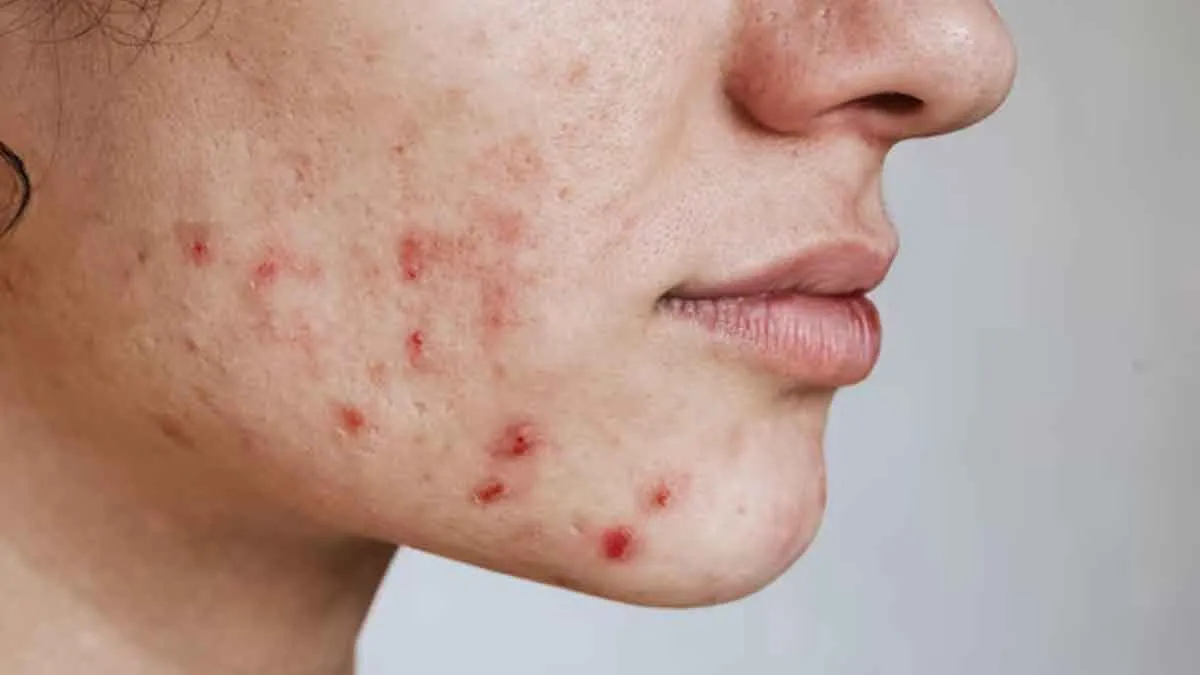 fungal vs regular acne 2