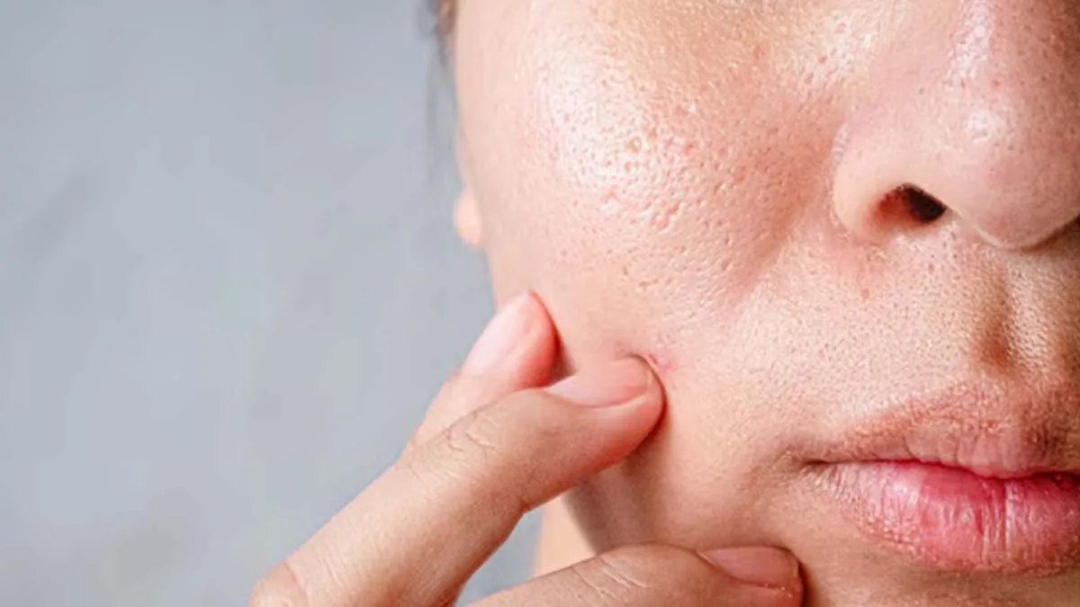 facial icing pores 2