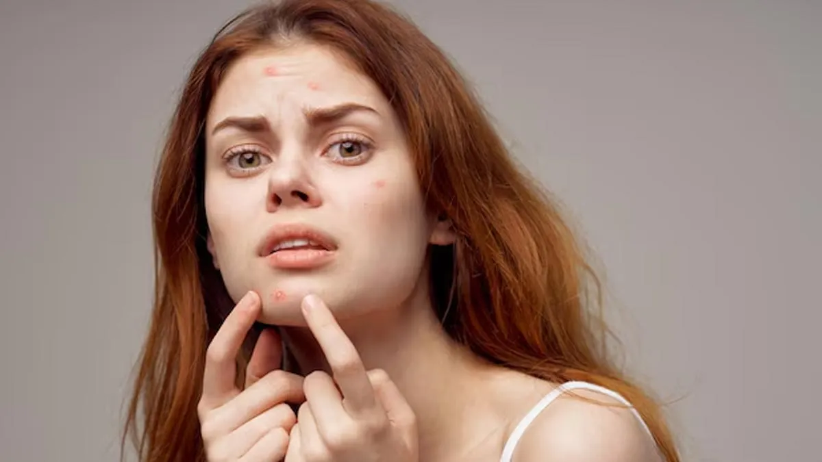 dairy acne 2