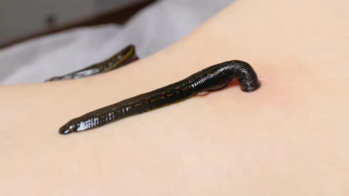 leech history 1