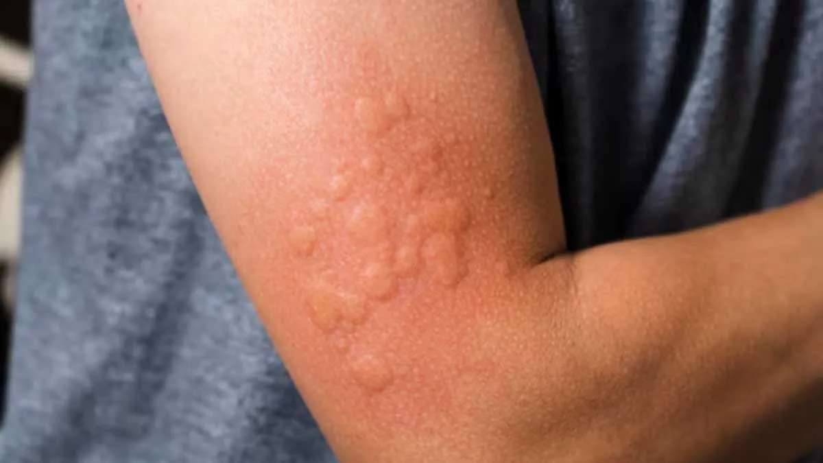 anxiety hives 3