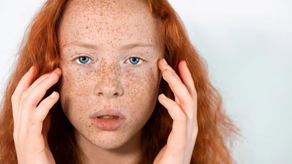 pregnancy melasma 3