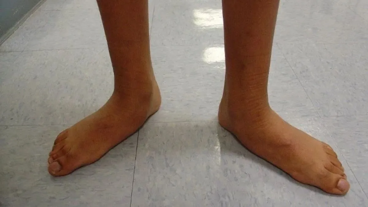 flat feet