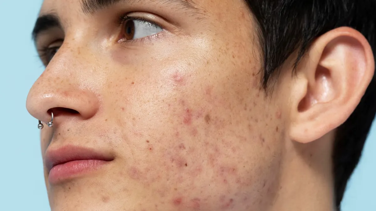 skin purging 3