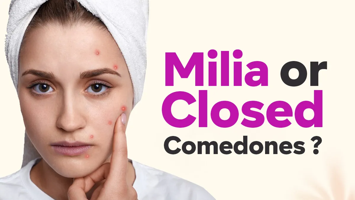 Tiny Bumps on Your Forehead: Is It Milia or Closed Comedones? Dermatologist Explains