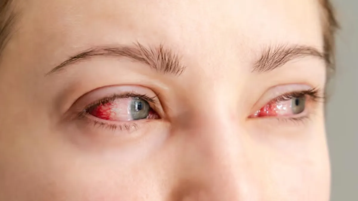Eyes Red After showering