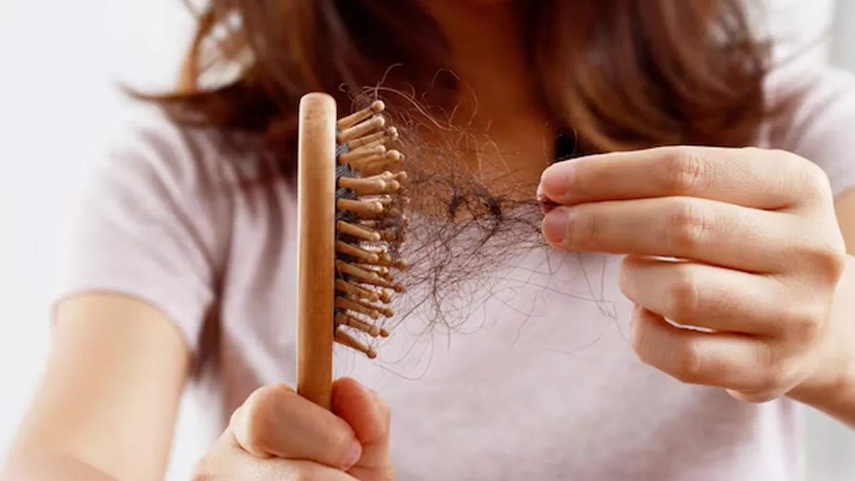 post dengue hair fall 2