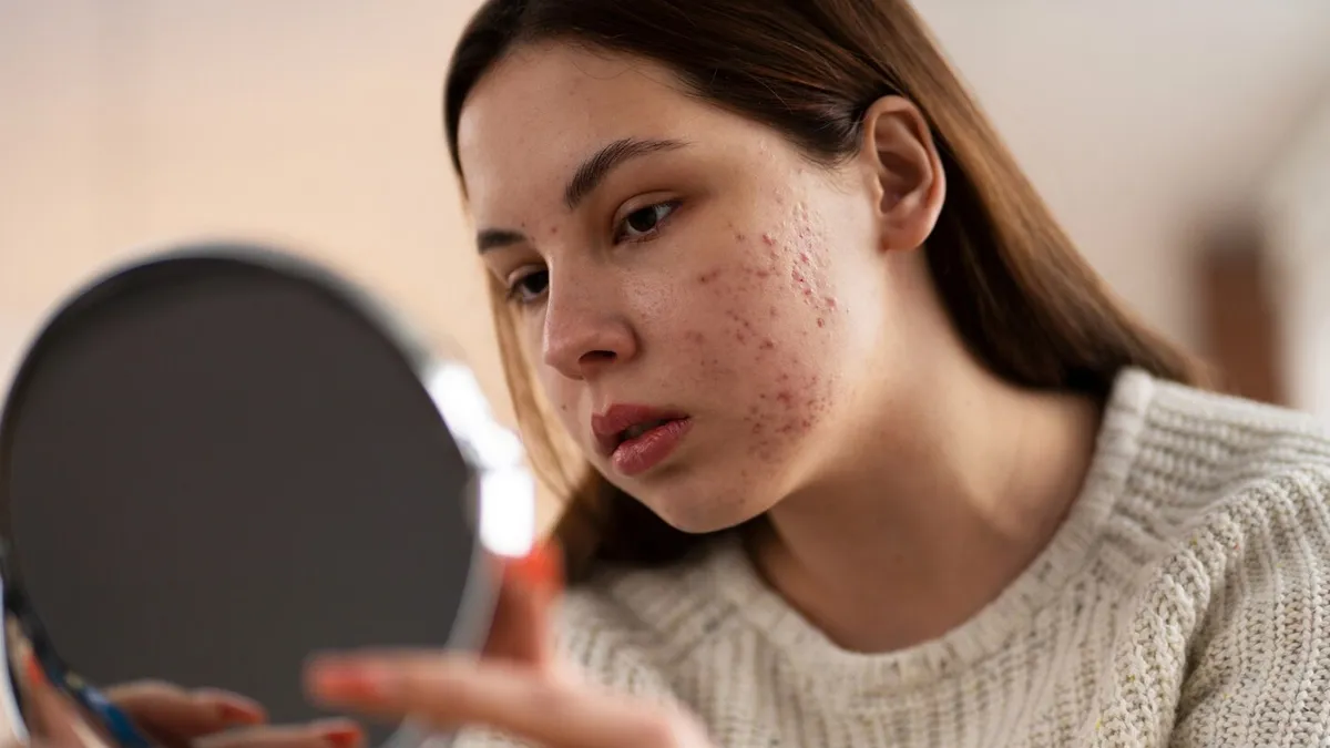 Acne Before Period
